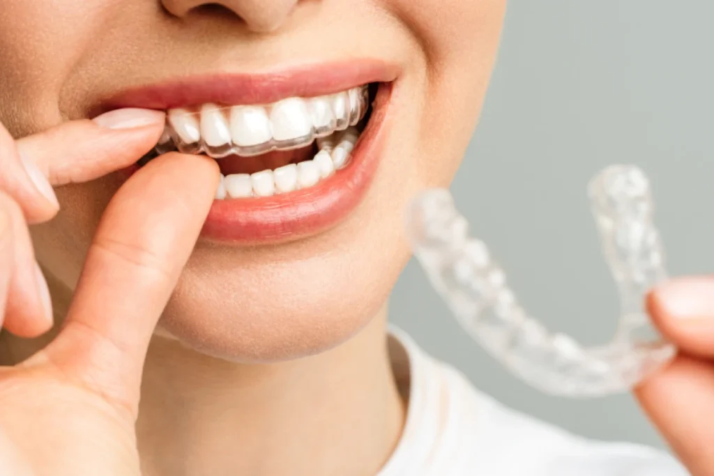 Orthodontiste Vourles Dr Kelly TILLY contention