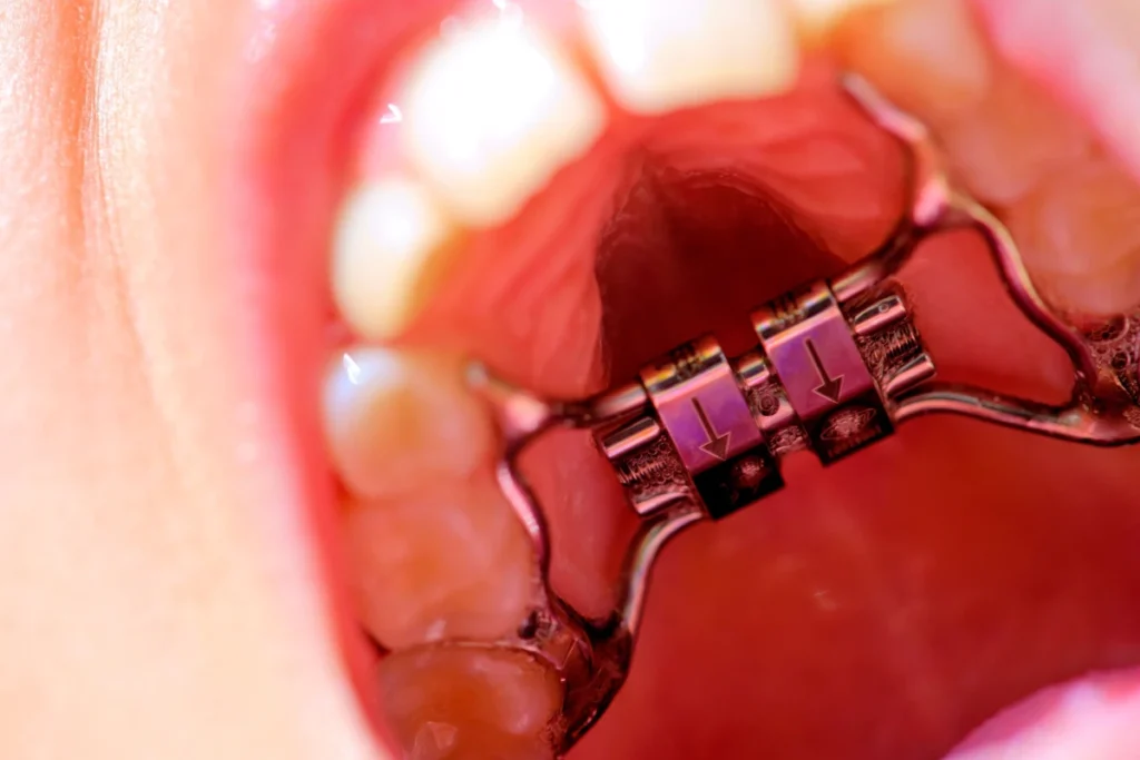 Les appareils fixes temporaires