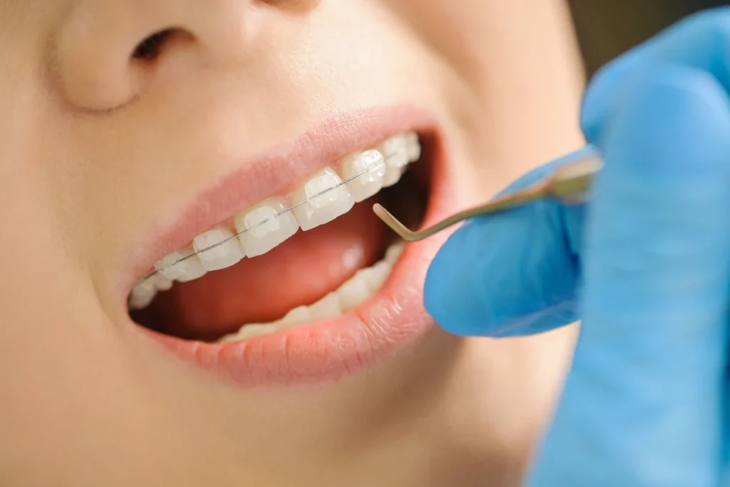 Orthodontiste adolescent Vourles Multi-attaches