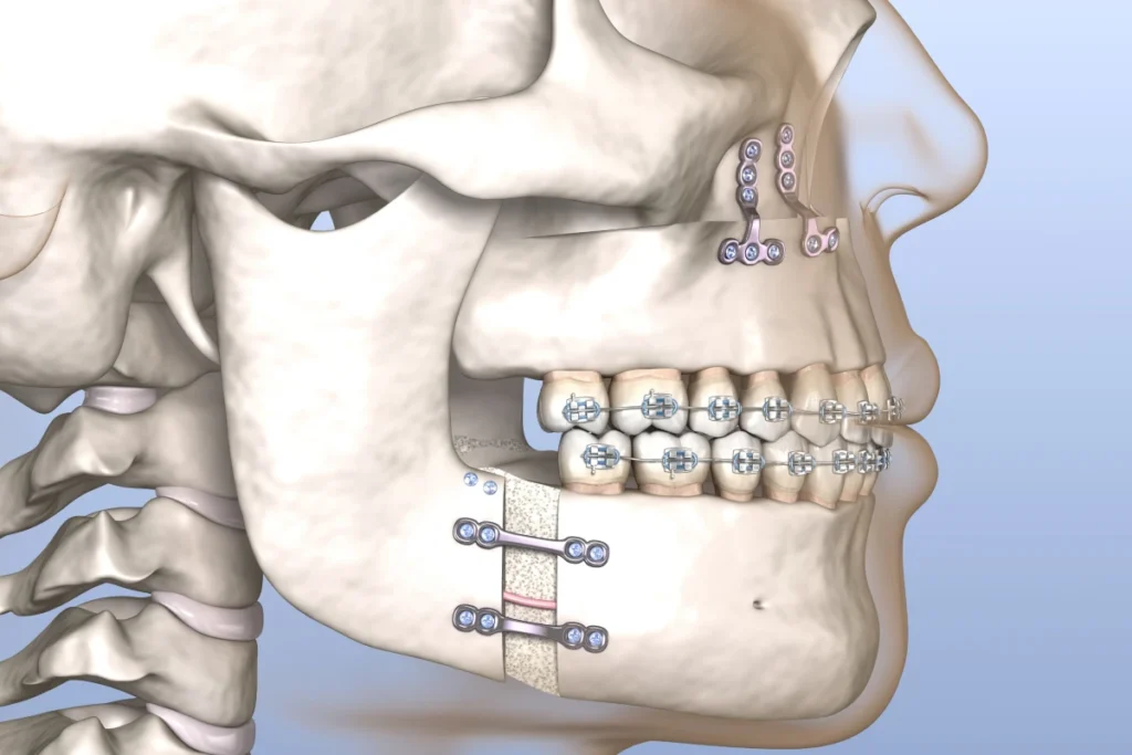 Orthodontiste adolescent Vourles Traitements ortho-chirurgicaux